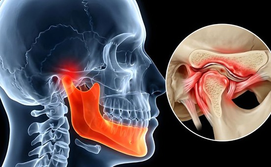 Illustration of a temporomandibular joint